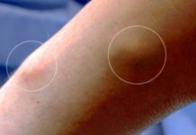 Жировик на руке под кожей: причины и симптомы — как избавиться