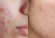 О проблемной коже лица: лечение прыщей и угрей в домашних условиях, что делать