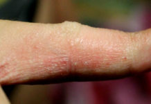 Экзема — все об экземе — Сыпи(высыпания)