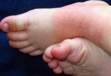 Экзема у детей: 8 фото, лечение, причины, симптомы профилактика