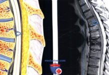 Лучевая диагностика эпидурального липоматоза