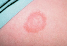 Эритема: фото, формы, причины, лечение, диагностика