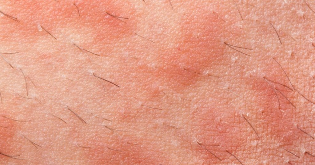 Жжение кожи: причины, лечение - Сыпи(высыпания)