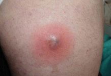 Прорвался фурункул: что делать дальше, чем обрабатывать, сколько заживает чирей после вскрытия, народные средства, профилактика