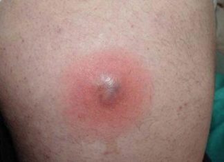 Прорвался фурункул: что делать дальше, чем обрабатывать, сколько заживает чирей после вскрытия, народные средства, профилактика