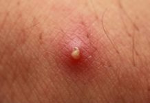 Как лечить фурункул, чтобы не заработать заражение крови — Лайфхакер