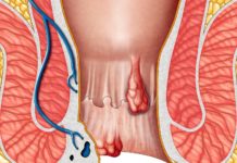 Шишка в заднем проходе: как лечить такой недуг?