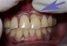 Гной в десне над зубом: что делать и как лечить гнойное воспаление в домашних условиях