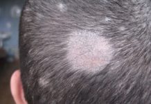Грибок кожи головы, микоз волосистой части головы