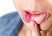 Сифилитическая сыпь во рту