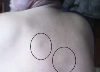 Лечение опоясывающего герпеса. Местная терапия опоясывающего герпеса