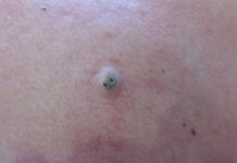 Прыщ с черной точкой внутри