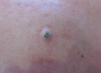 Прыщ с черной точкой внутри