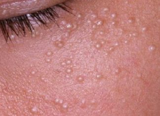 Водянистые прыщи на теле и лице: почему появляются и как быстро избавиться