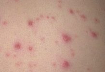 Как выглядит сыпь при ВИЧ фото: почему появляется сыпь при ВИЧ