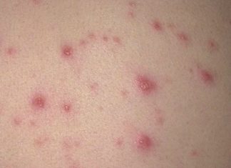 Как выглядит сыпь при ВИЧ фото: почему появляется сыпь при ВИЧ