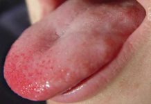 Красные пупырышки на языке у ребенка: выясняем причины и лечим
