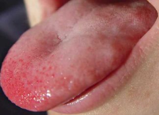 Красные пупырышки на языке у ребенка: выясняем причины и лечим