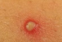 Что сделать чтобы фурункул быстрее прорвался — Всё о прыщах