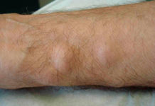 Жировик на ноге (ягодице, стопе, бедре), как избавится от таких липом