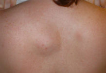 Шишка с черной точкой на спине: диета, как передается, как проявляется, народные средства