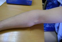 Заговоры степановой от жировиков