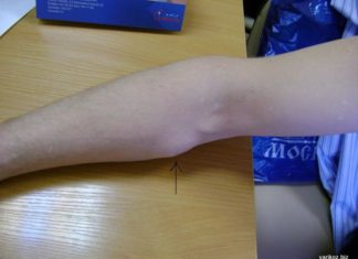 Заговоры степановой от жировиков