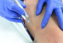 Липома: профилактика, удаление липомы лазером, на спине, на голове, на лице