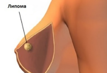 Липома молочной железы: лечение и удаление, чем опасна?