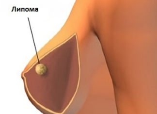 Липома молочной железы: лечение и удаление, чем опасна?