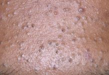 27 средств от прыщей на лице: эффетивная и недорогая мазь, крем, аптечные препараты и таблетки для лечения угревой сыпи и постакне