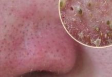 Как убрать черные точки в домашних условиях