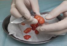 Удаление липомы