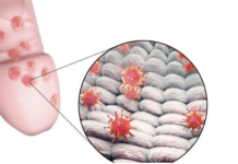 Что может вызвать появление сыпи на головке у мужчин?