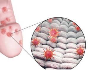 Что может вызвать появление сыпи на головке у мужчин?