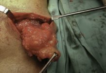 Тонзиллит: симптомы и лечение болезни, признаки и причины хронического тонзиллита — причины, диагностика и лечение