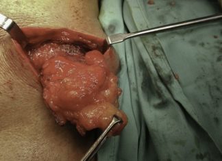 Экзема — Симптомы, причины, диагностика и лечение болезни — причины, диагностика и лечение