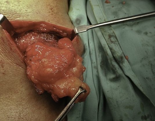 Беспокоит герпес? Укрепи иммунитет — причины, диагностика и лечение