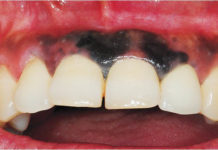 Черные точки на деснах, почему почернела десна около зуба