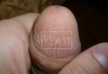 О чём говорят пупырышки на головке полового члена?