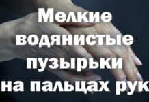 Водянистые пузырьки на пальцах рук: мелкие, лечение, как лечить