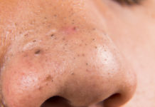 Черные точки или комедоны на носу: способы избавления