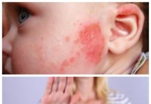 Аллергия у грудничка на лице: фото, лечение и симптомы аллергической сыпи у новорожденных детей