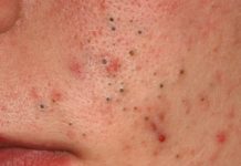 Эфирные масла от прыщей на лице: самый эффективный состав, способы применения