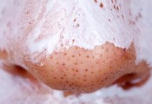 Как избавиться от черных точек на лице в домашних условиях быстро и навсегда