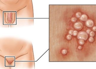 Белые прыщики на половом члене: на головке пениса, симптомы, профилактика и лечение