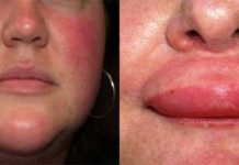 Аллергические высыпания на лице у взрослых и детей: лечение, мази и фото