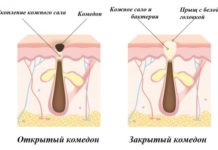 Как избавиться от черных точек на лице в домашних условиях: быстро и эффективно убрать открытые комедоны лимоном, солью и другими средствами