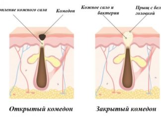 Как избавиться от черных точек на лице в домашних условиях: быстро и эффективно убрать открытые комедоны лимоном, солью и другими средствами