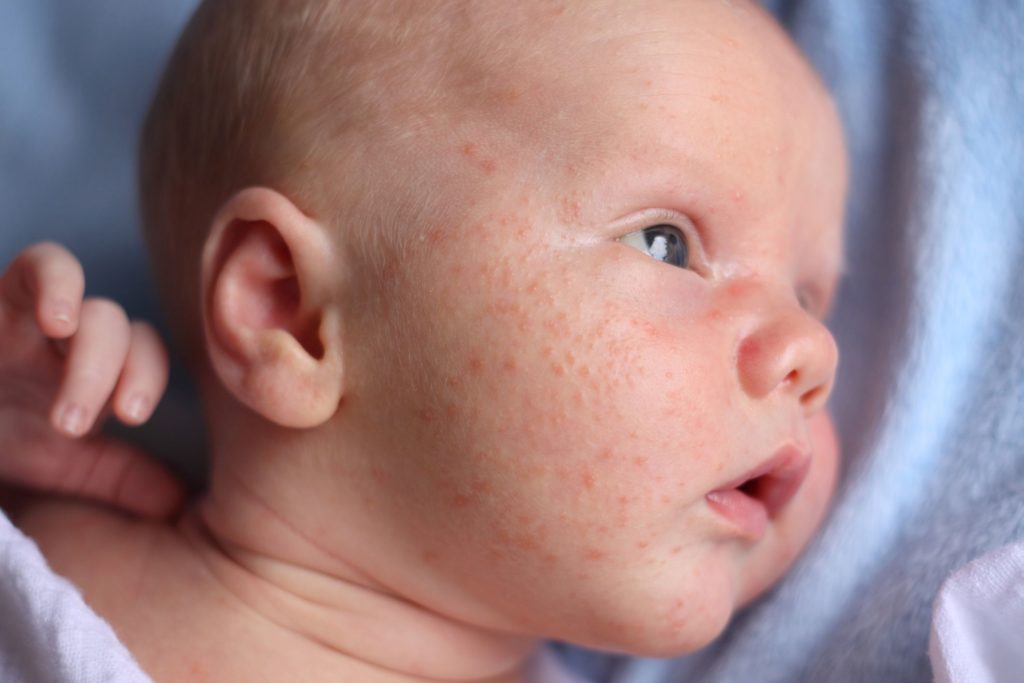 Гормональная сыпь у новорожденных: фото трехнедельных неонатальных прыщиков у детей